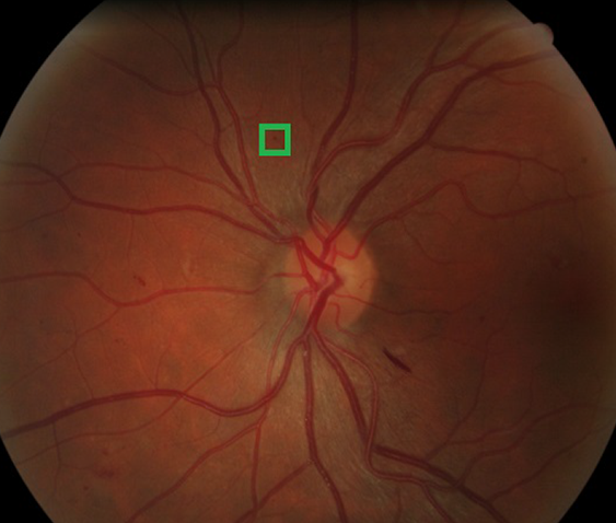 Image of a retina containing a retinal lesion; highlighted green box