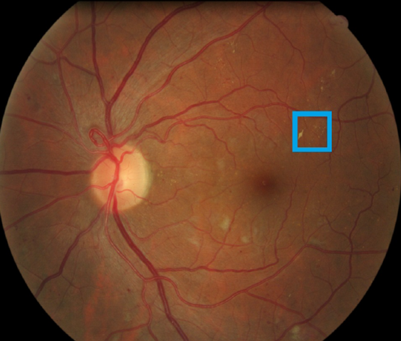 Image of a retina containing a retinal lesion associated with diabetic retinopathy highlighted in blue box
