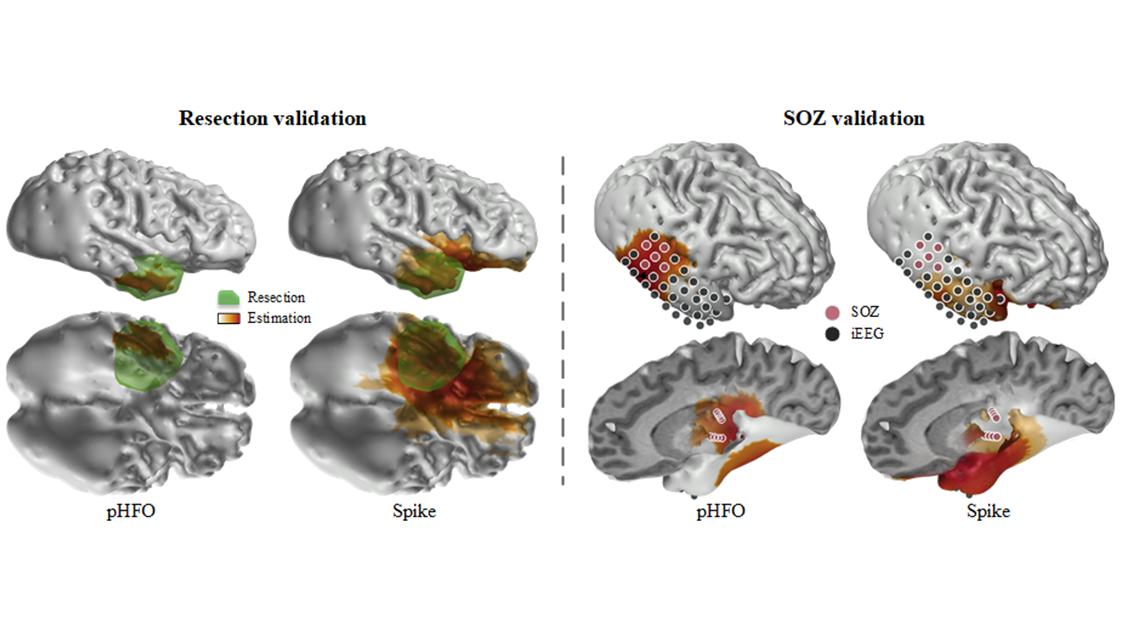 Technical graphic showing resection and SOZ validation