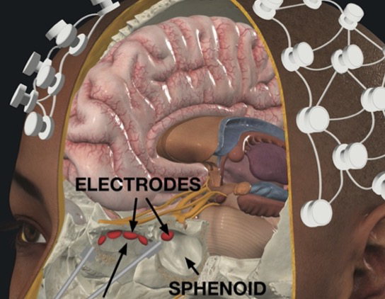 An illustration of a brain with electrodes attached, highlighting various regions and their functions.