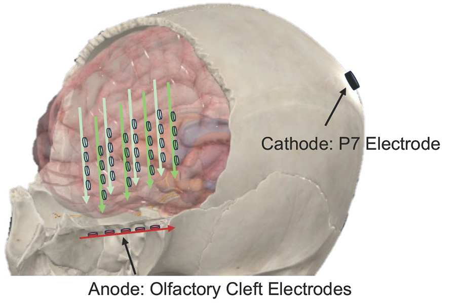 TnES uses close proximity and highly conductive pathways offered by thin bones between the nasal cavity and brain to create larger and more accurate electric fields in deep brain regions than traditional scalp electrode configurations.