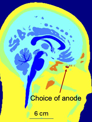 By targeting the brain’s “reward circuit” (the orbitofrontal cortex, Brodmann area 25, amygdala, etc.) and managing environmental and time of day factors, DeepFocus could disrupt the brain’s associations with cravings. This could help treat neural conditions like addiction and substance abuse disorder.