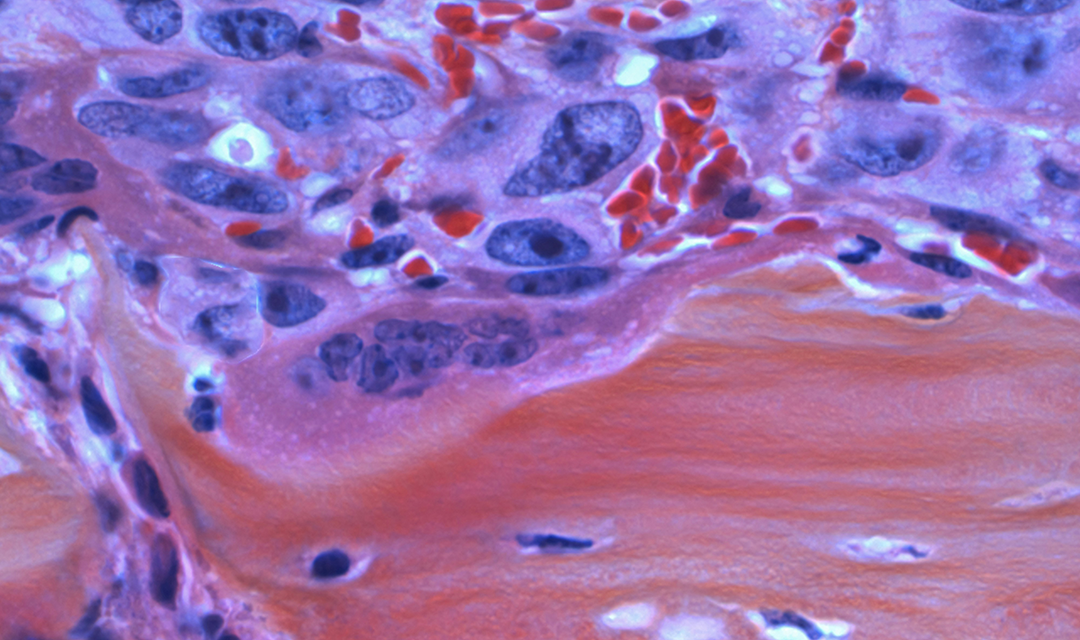 Image of cancer cells from under a microscope