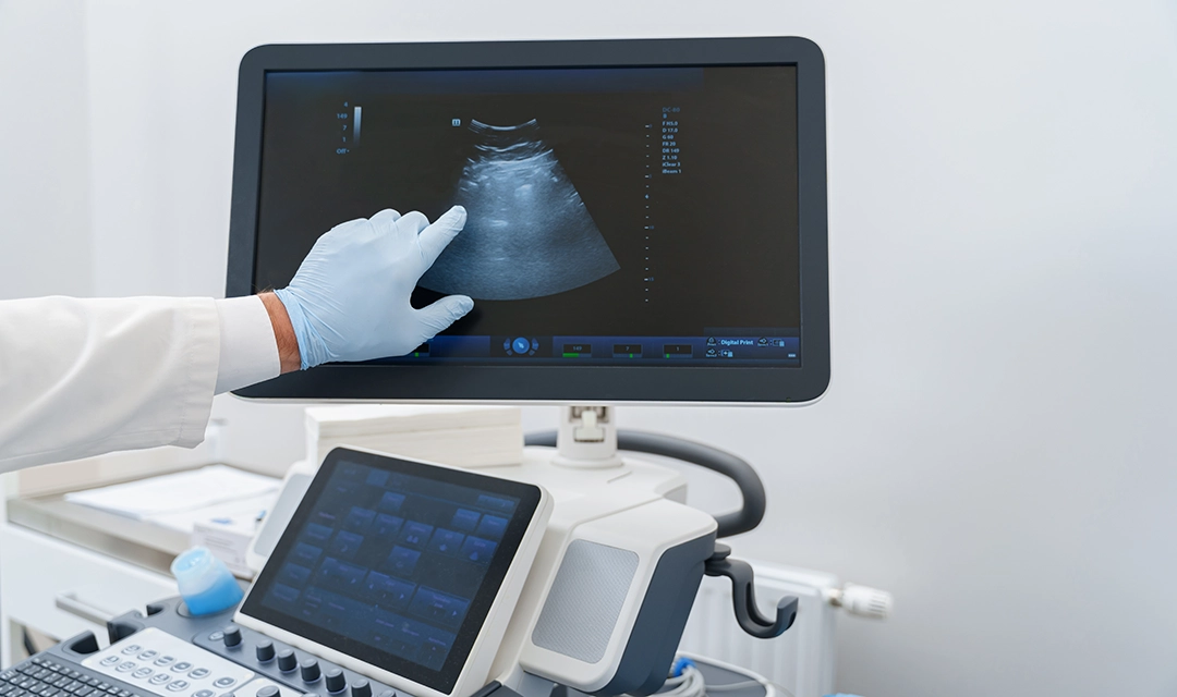 A gloved hand pointing at an ultrasound screen