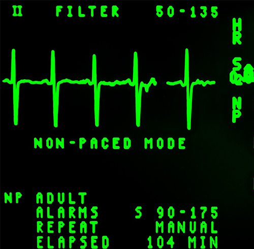 EKG screen