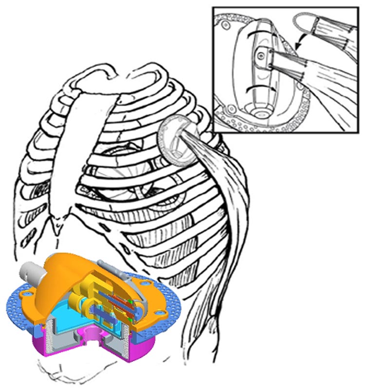 Artificial heart assist